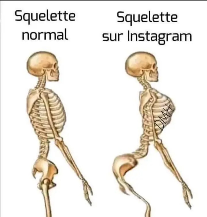 Squelette normal. Squelette sur Instagram.